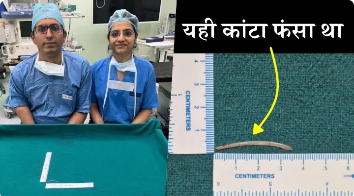 पटना एम्स की बड़ी कामयाबी: 35 मिमी मछली का कांटा निकालकर बचाई मरीज की जिंदगी, लिमका बुक में दर्ज हुआ रिकॉर्ड