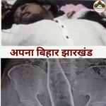 पलामू में युवक के प्राइवेट पार्ट से निकली कोल्ड ड्रिंक की बोतल, पेट दर्द के बाद अस्पताल पहुंचा मामला