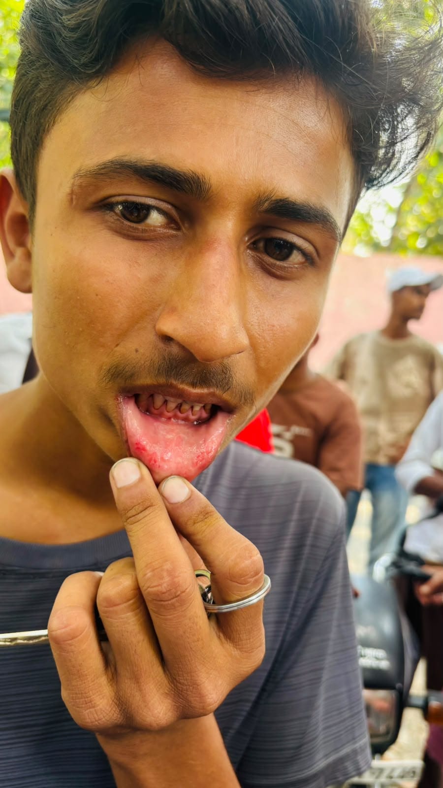 मोतिहारी में आइसक्रीम खाने से आधा दर्जन बच्चे बीमार, होंठ चिपकने और खून निकलने का आरोप; विक्रेता हिरासत में