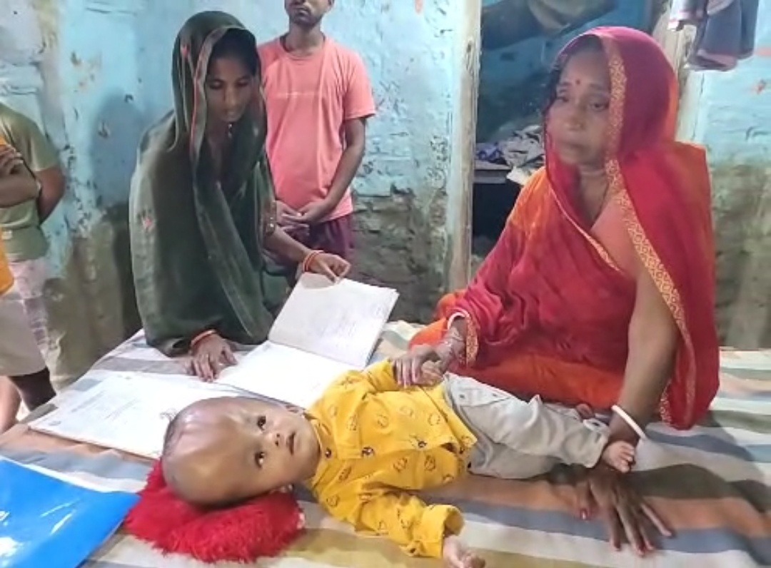 18 महीने के मासूम के सिर का वजन 10 किलो! इलाज के लिए अस्पतालों के चक्कर काट रहे माता-पिता, अब सरकार से लगाई मदद की गुहार